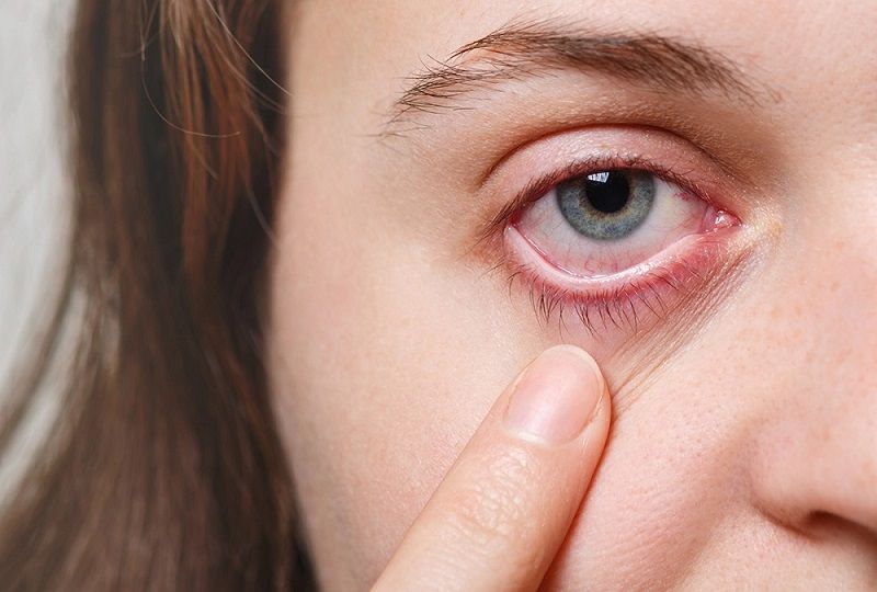 Cách xử lý khi lông mi rơi vào mắt