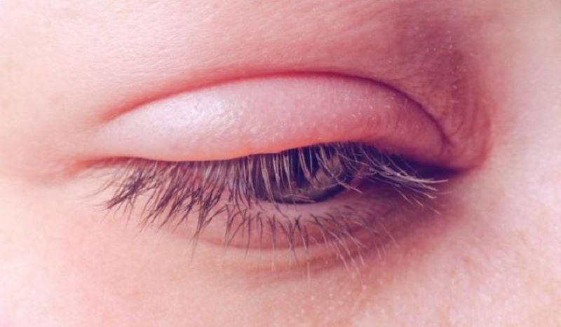 Cách xử lý khi lông mi rơi vào mắt
